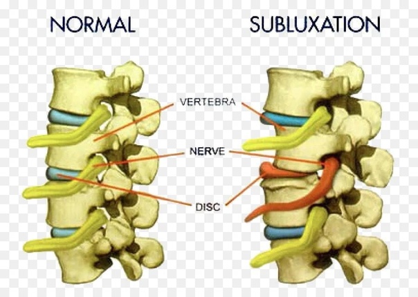 Be Subluxation Free with Premier Chiropractic on Sunshine Coast